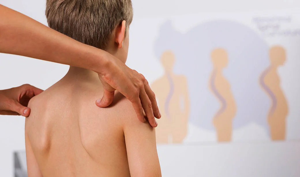 اسکولیوز (scoliosis) چیست | راه های درمان انحراف ستون فقرات