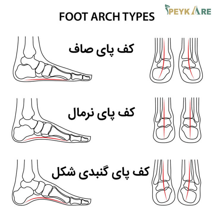 درمان کف پای صاف با کفی و کفش ارتوپدی