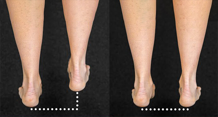 درمان کوتاهی پا با کفش ارتوپدی و کفی اختصاصی