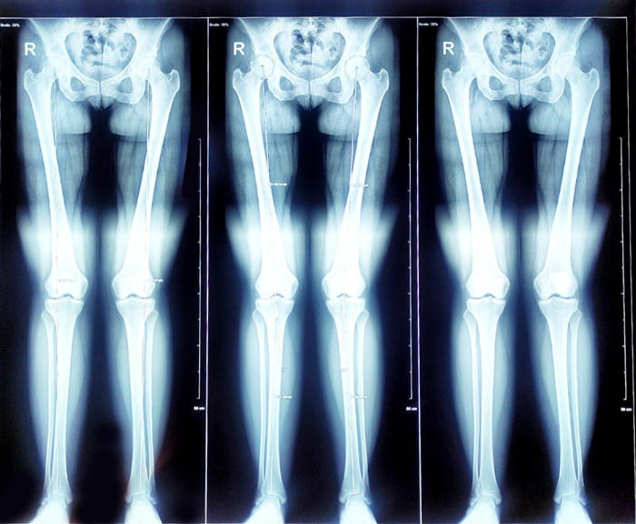 نمونه عکس اسکنوگرام برای تشخیص مقدار کوتاهی پا