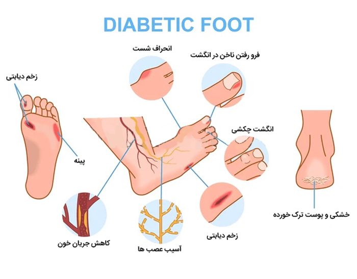 عوارض دیابت بر روی پا و اهمیت ساخت کفش دیابتی