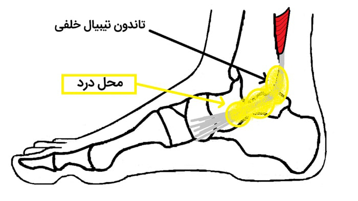 اختلال عملکرد تاندون تیبیال خلفی (PTTD)