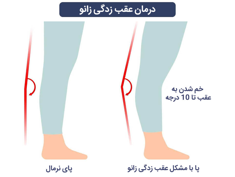 ‫‬درمان عقب زدگی زانو