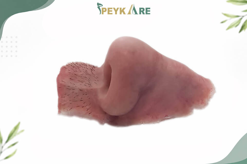 ساخت بینی مصنوعی (مراحل بالینی، روش های اتصال و هزینه ها)