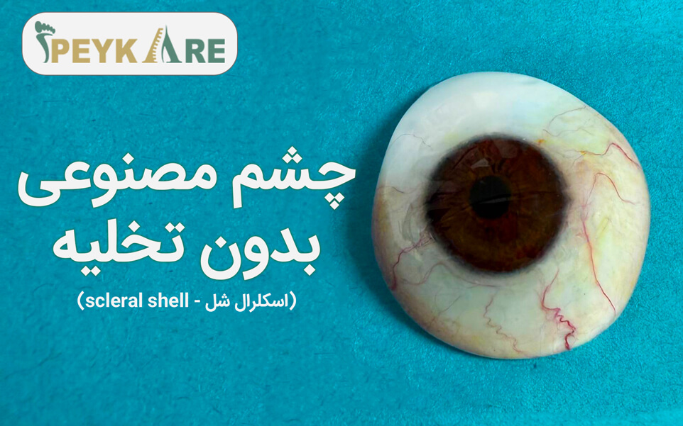 پروتز چشم بدون تخلیه (اسکلرال شل)